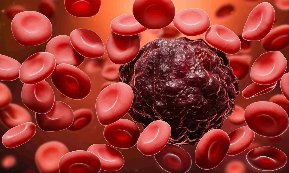 Blood cancer specialist in Hyderabad
