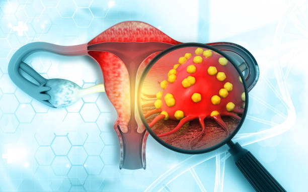 Cervical Cancer Treatment in Hyderabad