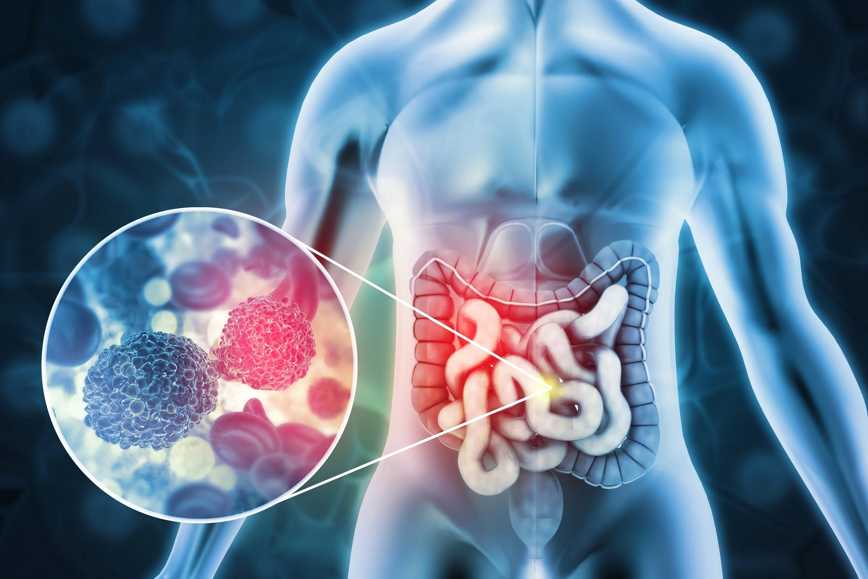Colon Cancer Treatment in Hyderabad