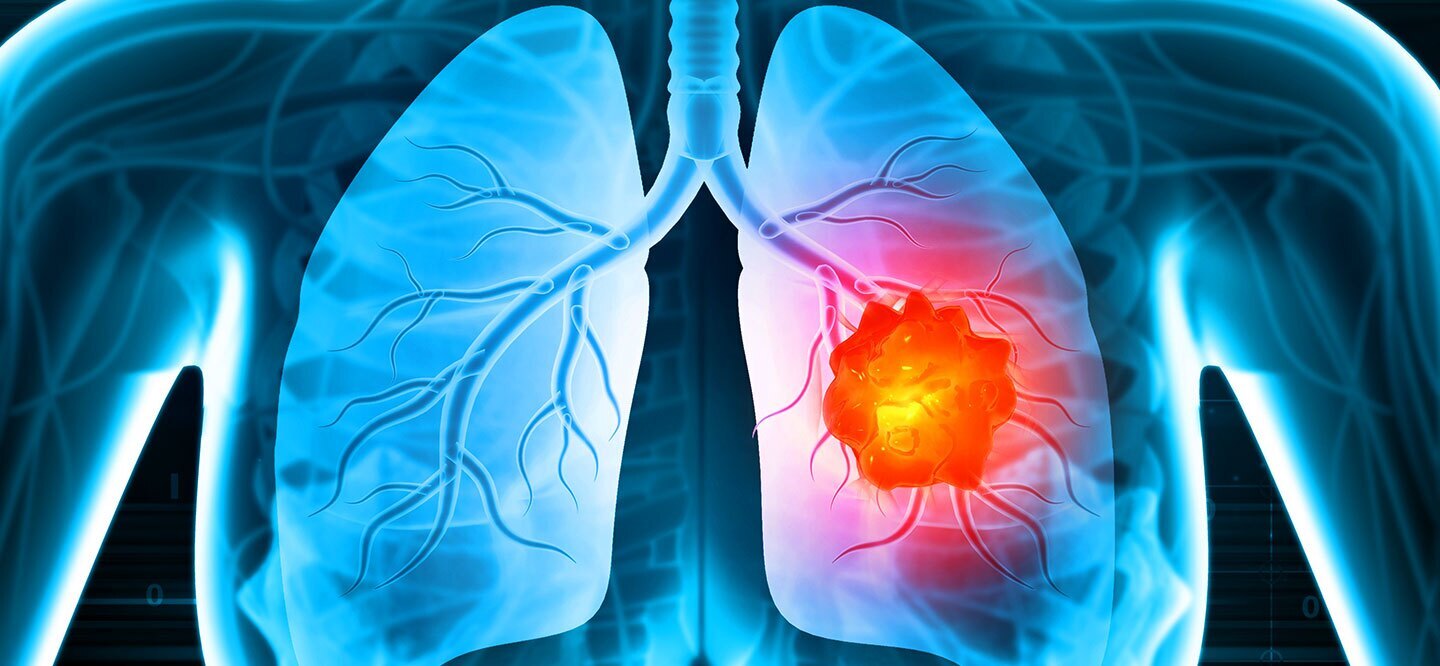 Lung Cancer Treatment in Hyderabad