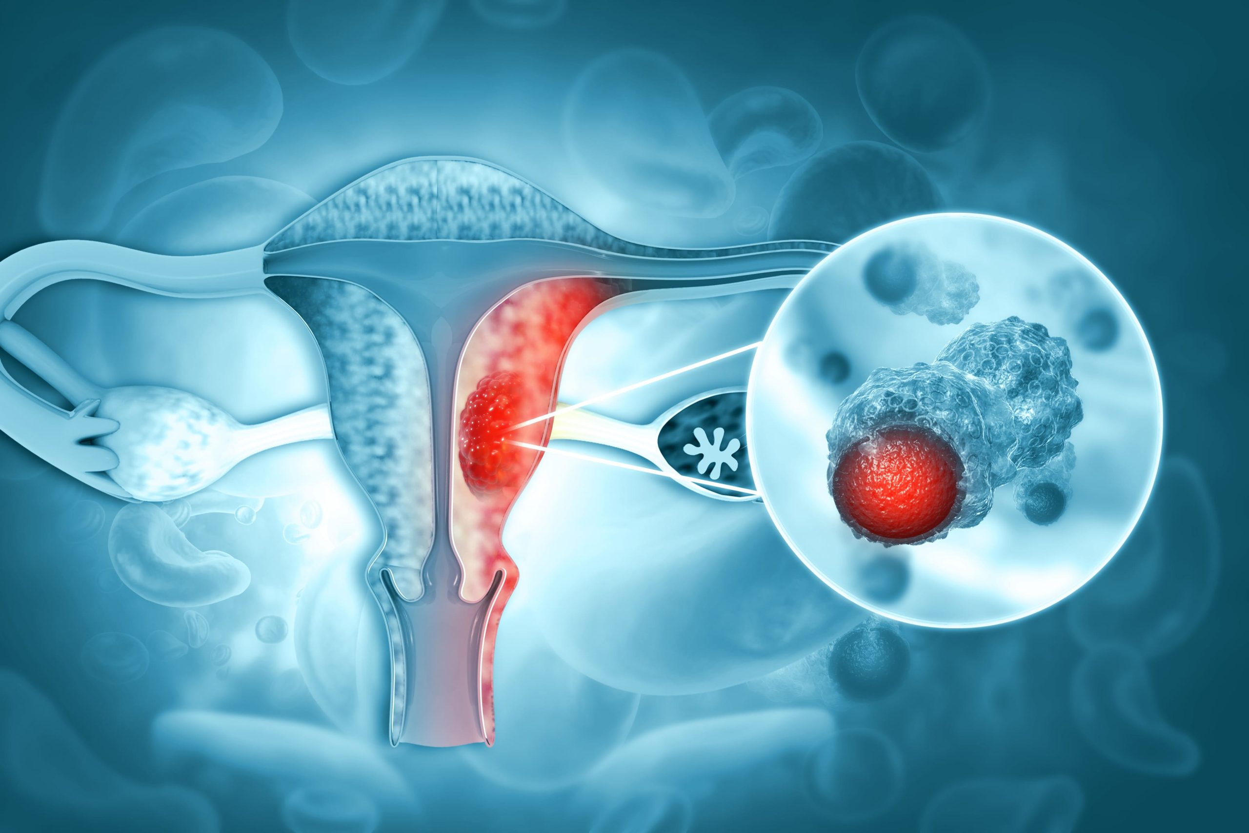 Ovarian Cancer Treatment in Hyderabad