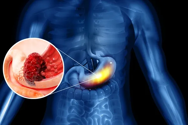 Stomach Cancer Treatment in Hyderabad