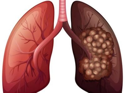 lung cancer Lung Cancer Service