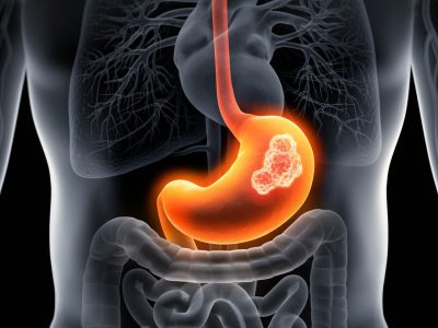 stomach cancer Stomach Cancer Service